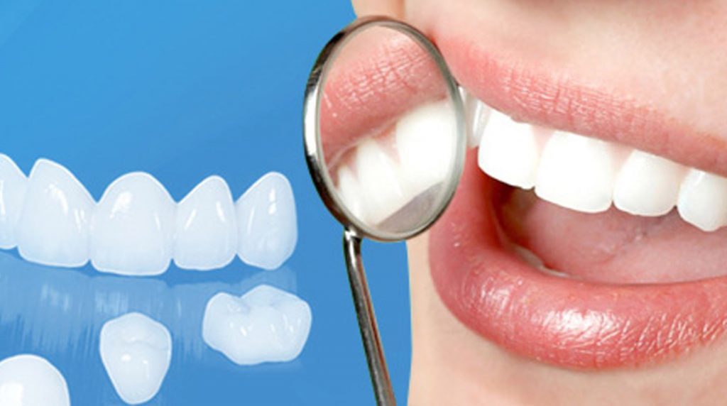 Hiệu quả bọc răng sứ Cercon là gì ?