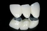 Răng sứ kim loại thường có tốt không?