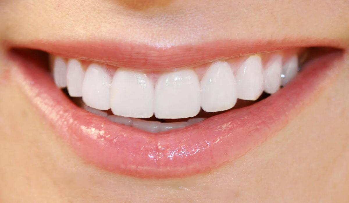 Răng sứ kim loại thường có tốt không? 3