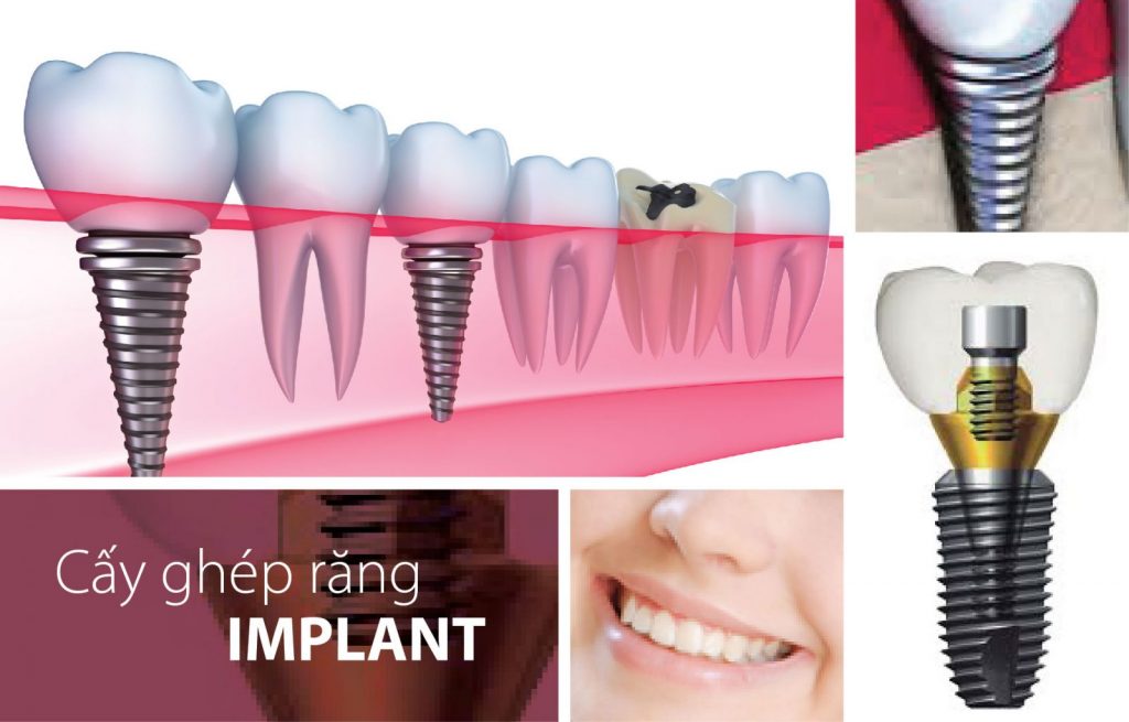 Thời gian thích hợp để cấy ghép răng với Implant