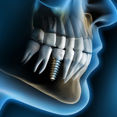 Cấy ghép răng Implant bền đẹp