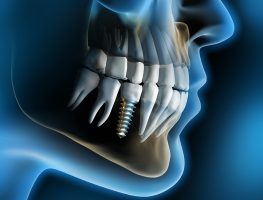 Cấy ghép răng Implant bền đẹp