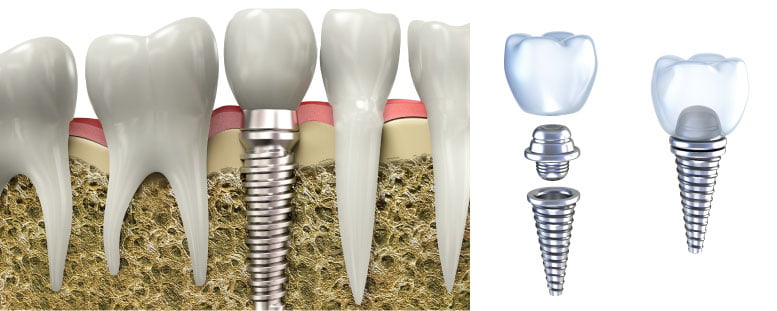 Cấy ghép răng Implant như thế nào? 3
