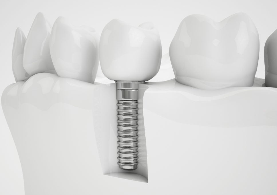  Chi phí trồng răng implant bao nhiêu là hợp lý-1