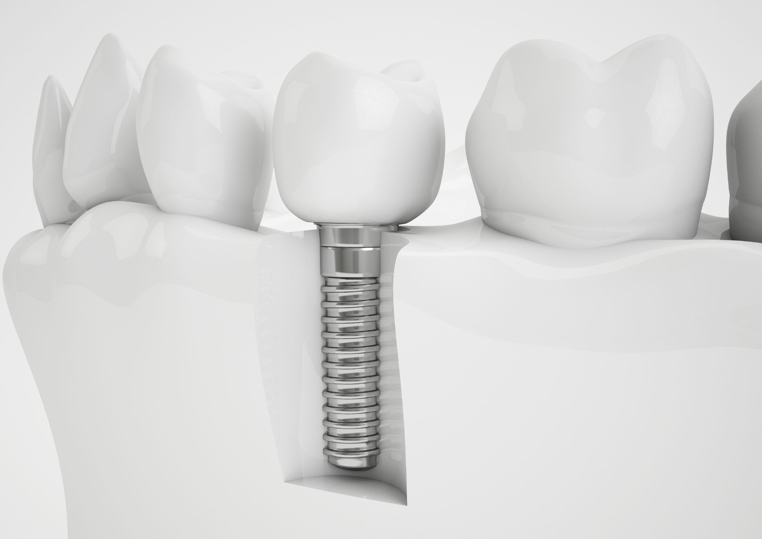 Phương pháp cấy ghép răng Implant là gì ?