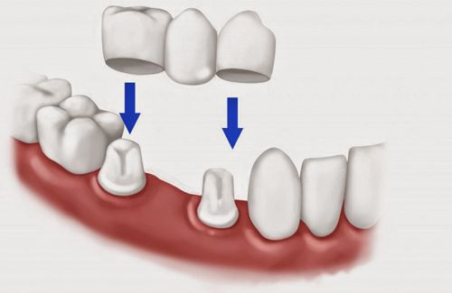 Phương pháp trồng răng sứ thẩm mỹ hiện nay 2
