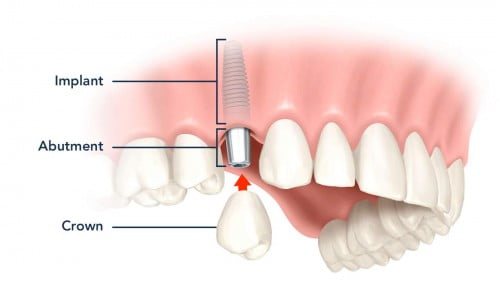Phương pháp trồng răng sứ thẩm mỹ hiện nay