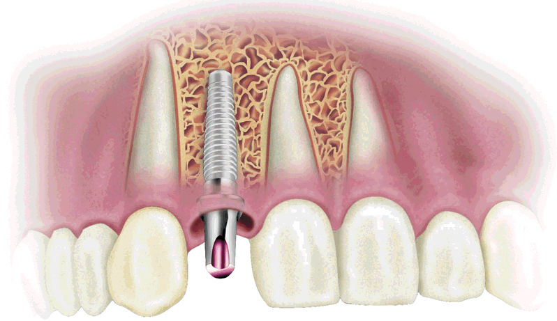 Quá trình cấy ghép Implant cho răng cửa