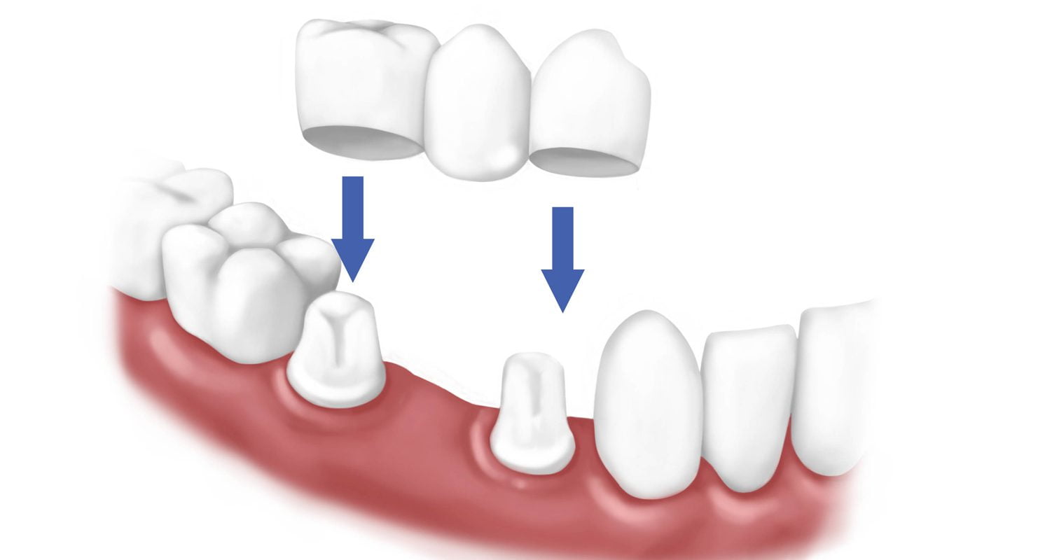 Chi phí trồng răng implant bao nhiêu ?