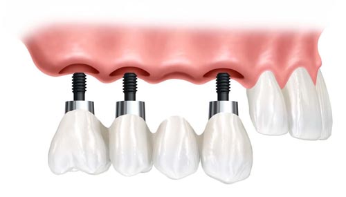 Chi phí trồng răng implant bao nhiêu-2