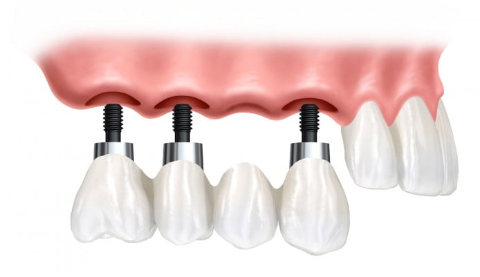 Trồng răng Implant mất bao lâu? 2
