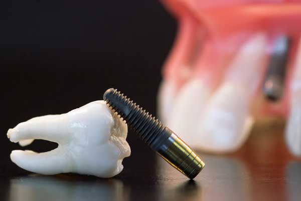 Trồng răng Implant ở đâu tại TPHCM?