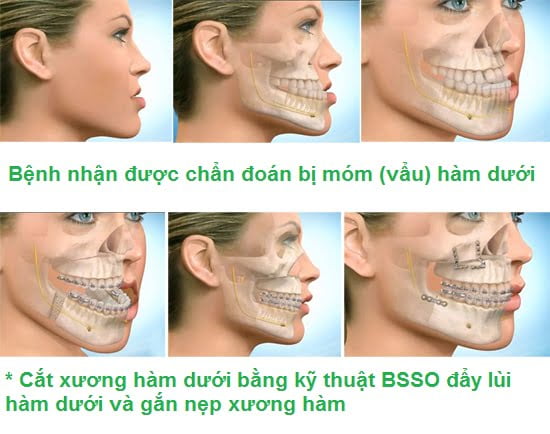 Quy trình phẫu thuật hàm móm như thế nào? Quy trình phẫu thuật hàm móm như thế nào?