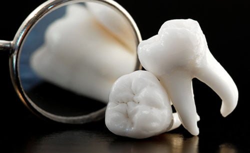 Răng khôn mọc lệch có nên nhổ không? Răng khôn mọc lệch có nên nhổ không?