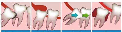 Răng khôn mọc lệch có nên nhổ không?