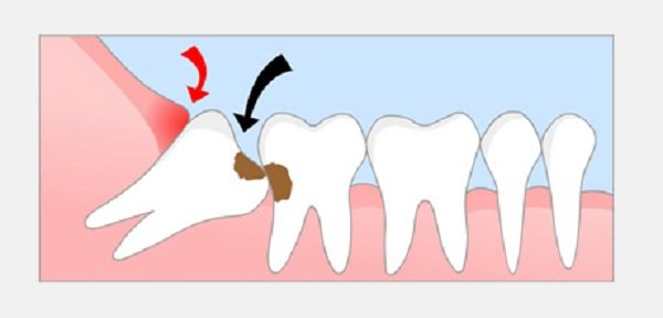 Răng khôn mọc lệch có nên nhổ không?