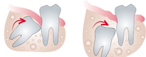 Đau răng khôn nguyên nhân do đâu - Cách xử lý 2