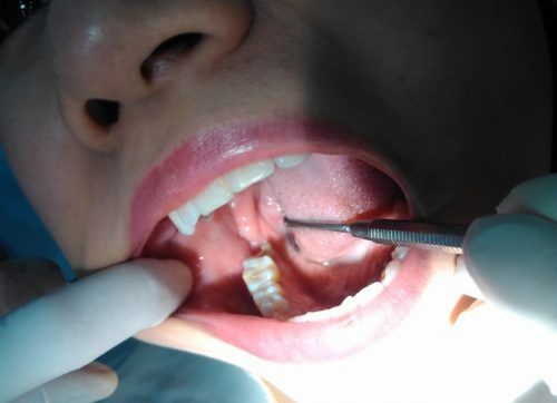 Theo dân gian - Mọc răng khôn có ý nghĩa gì? 3