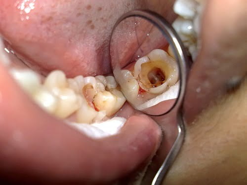 Răng khôn bị sâu nên nhổ hay trám? 2 Răng khôn bị sâu nên nhổ hay trám? 2