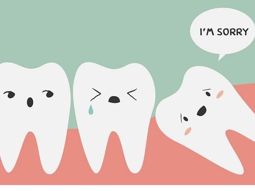 Tình trạng răng khôn mọc lệch ra má phải làm sao?1 Tình trạng răng khôn mọc lệch ra má phải làm sao?1