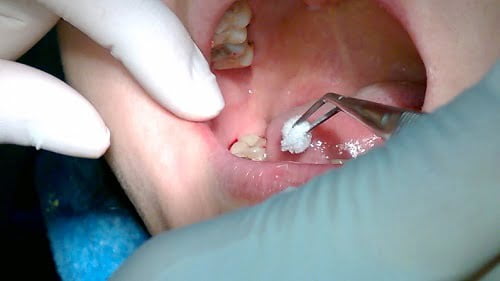 Tình trạng răng khôn mọc lệch ra má phải làm sao?2