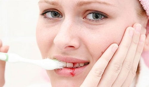 Chảy máu chân răng khi đánh răng dấu hiệu bệnh gì? 1