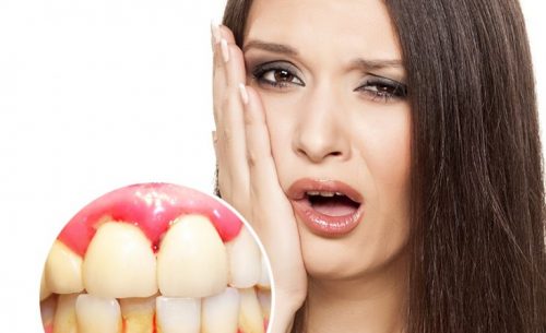 Chảy máu chân răng khi đánh răng dấu hiệu bệnh gì? 2