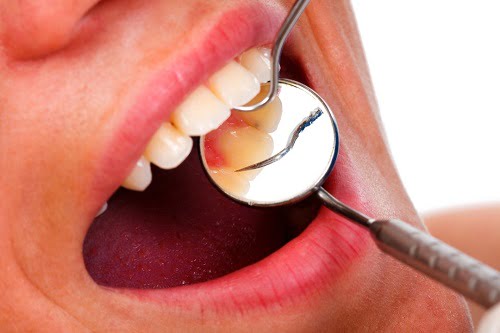 Chảy máu chân răng là thiếu vitamin gì? 2