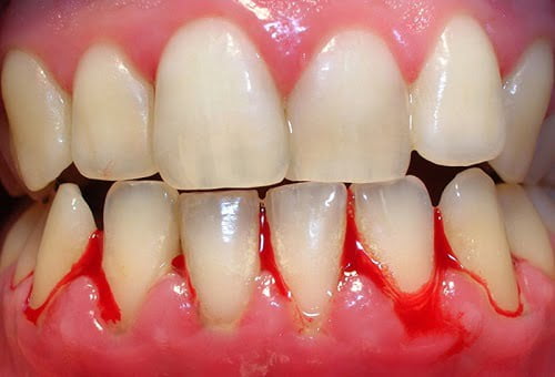 Nướu răng bị chảy máu phải làm sao? Nguyên nhân nướu răng bị chảy máu  1