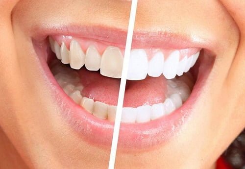 Nướu răng bị chảy máu phải làm sao? Nguyên nhân nướu răng bị chảy máu 2 Nướu răng bị chảy máu phải làm sao? Nguyên nhân nướu răng bị chảy máu 2