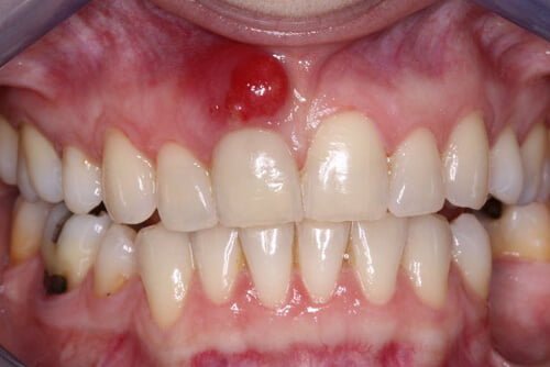 Sưng nướu răng cần xử lý như thế nào? 2
