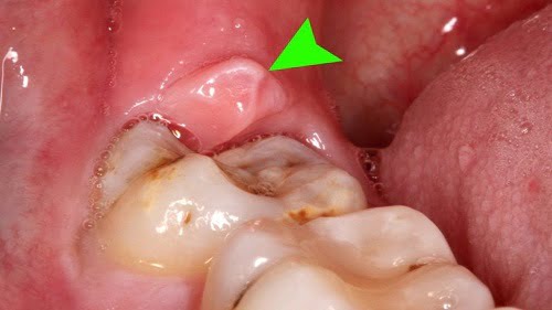 Sưng nướu răng trong cùng có ảnh hưởng gì không? 1