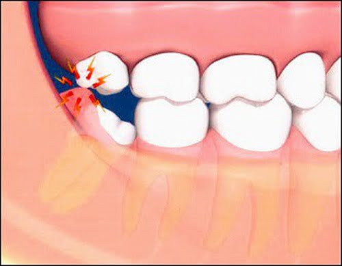 Sưng nướu răng trong cùng có ảnh hưởng gì không? 3