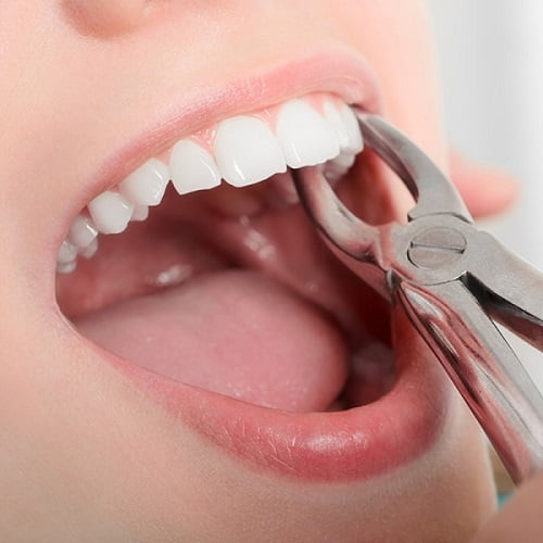 Nhổ răng khôn hàm trên mọc lệch an toàn 2 Nhổ răng khôn hàm trên mọc lệch an toàn 2