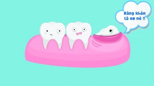 Nhổ răng khôn hàm trên mọc lệch an toàn 3