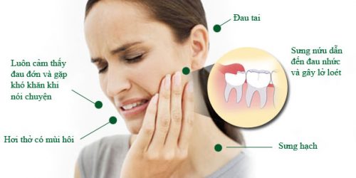 Răng khôn mọc ở vị trí nào trên hàm răng vĩnh viễn? 1