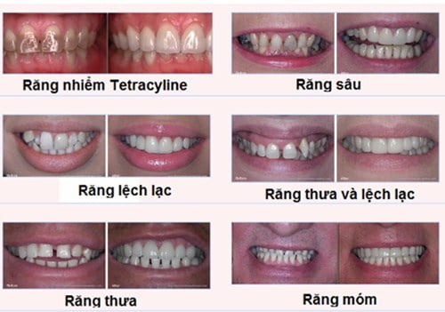 Khôi phục hàm nhai với bọc mão răng sứ 1 Khôi phục hàm nhai với bọc mão răng sứ 1