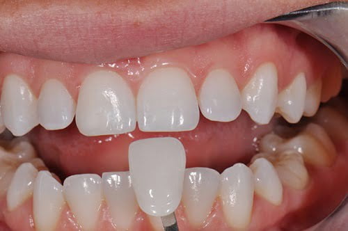Biện pháp bọc răng sứ chữa hô có thực sự hiệu quả-2