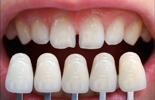 Bọc răng sứ không cần mài răng và ưu điểm vượt trội