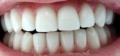 Bọc răng sứ không cần mài răng bạn đã biết? 3
