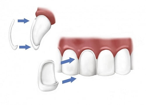Mặt dán răng sứ thẩm mỹ có hiệu quả lâu dài-1