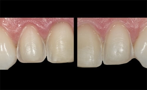 Mặt dán răng sứ thẩm mỹ có hiệu quả lâu dài-2