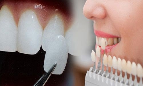 Mặt dán răng sứ thẩm mỹ có hiệu quả lâu dài-3
