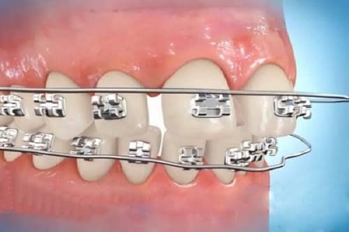 Phương pháp niềng răng mắc cài 3m ugsl hiệu quả cao không?