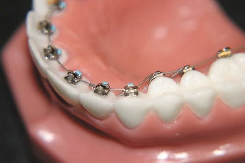 Kỹ thuật niềng răng mắc cài mặt lưỡi - 4 ưu điểm vượt trội-1