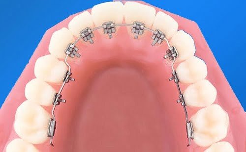 Kỹ thuật niềng răng mắc cài mặt lưỡi - 4 ưu điểm vượt trội-3