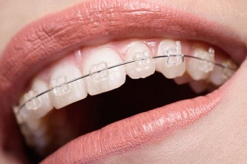 Mức chi phí trung bình niềng răng người lớn giá bao nhiêu tại các nha khoa?