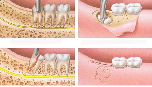 3 biểu hiện để biết răng khôn có mấy cái 