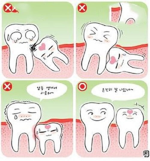 Răng khôn mọc khi nào - 3 dấu hiệu để biết răng khôn mọc 