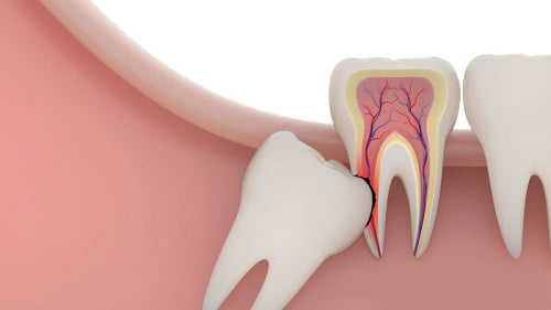 Răng khôn mọc khi nào - 3 dấu hiệu để biết răng khôn mọc 3